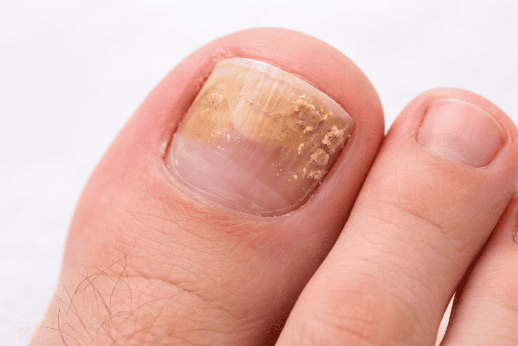 Close-up of a discoloured and thickened toenail affected by fungal infection