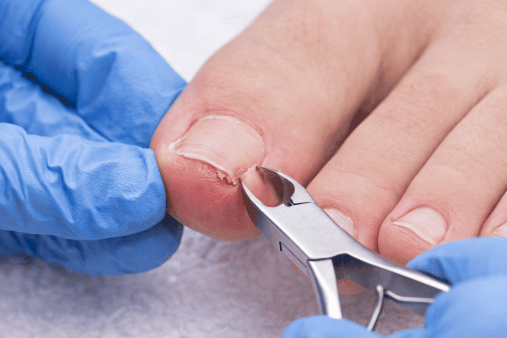 Podiatrist treating an ingrown toenail